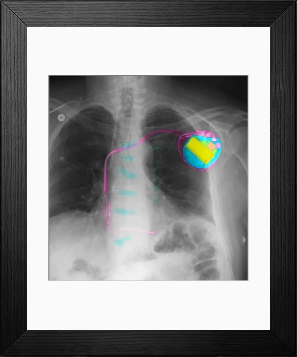 Framed Print : Pacemaker. Color-enhanced chest X-ray showing a pacemaker