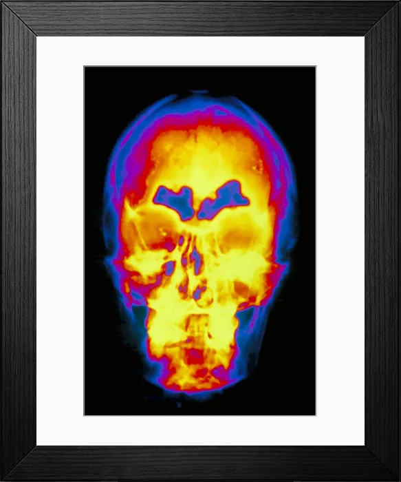 Framed Print : Sinusitis Framed Print : Sinusitis
