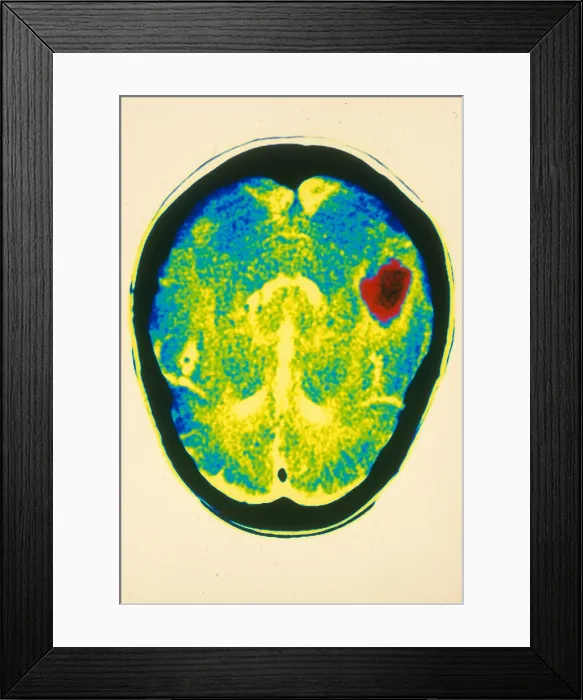 Framed Print : Hemorrhagic stroke, CT Scan Framed Print : Hemorrhagic stroke, CT Scan