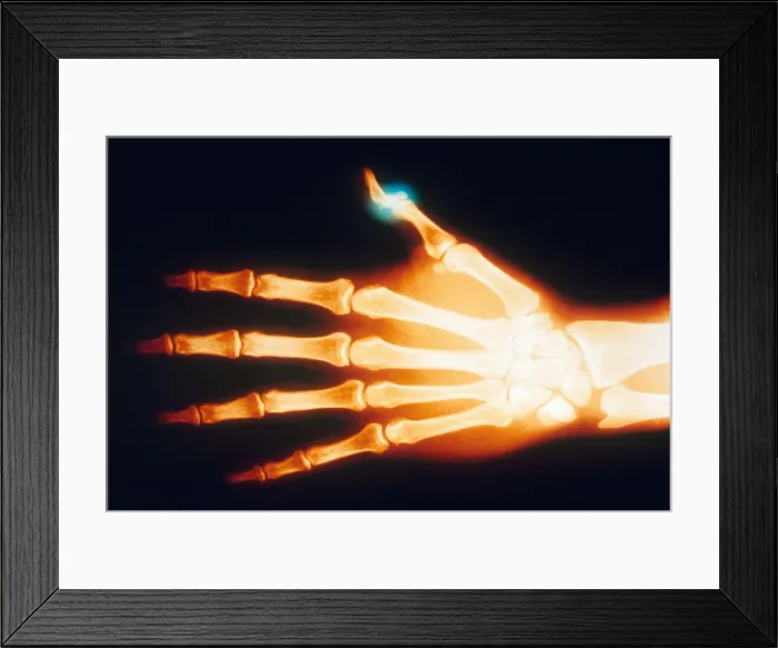 Framed Print : Fractured Thumb, X-ray Framed Print : Fractured Thumb, X-ray