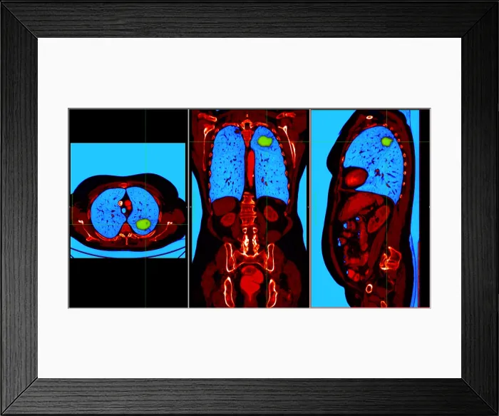Framed Print : Lung Cancer, CT Scan