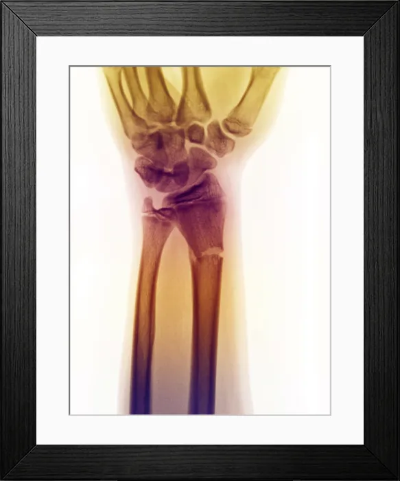 Framed Print : Distal Radius Fracture in a 14 Year Old Boy Framed Print : Distal Radius Fracture in a 14 Year Old Boy