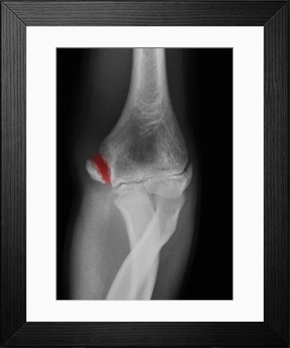 Framed Print : Little League Elbow Syndrome Framed Print : Little League Elbow Syndrome