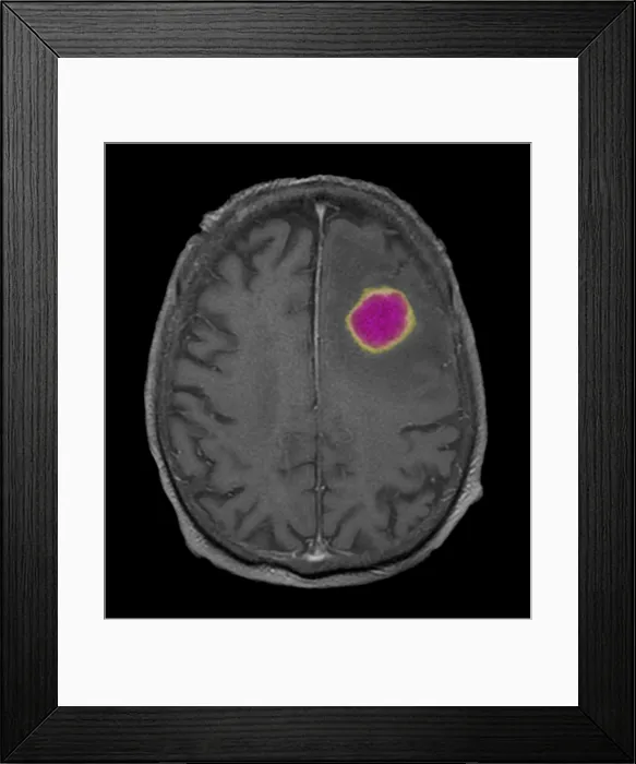 Framed Print : MRI of Encapsulated Abscess in Frontal Lobe Framed Print : MRI of Encapsulated Abscess in Frontal Lobe