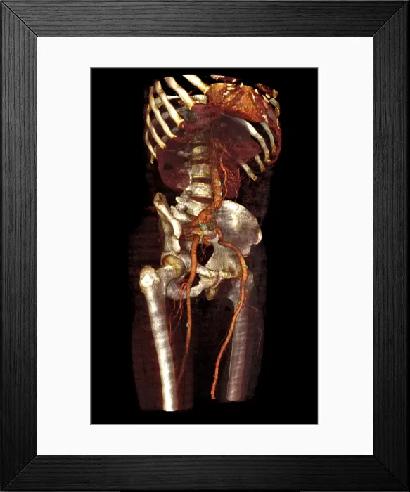 Framed Print : Aneurysm. Lower limb angio CT of a patient with atherosclerotic changes Framed Print : Aneurysm. Lower limb angio CT of a patient with atherosclerotic changes