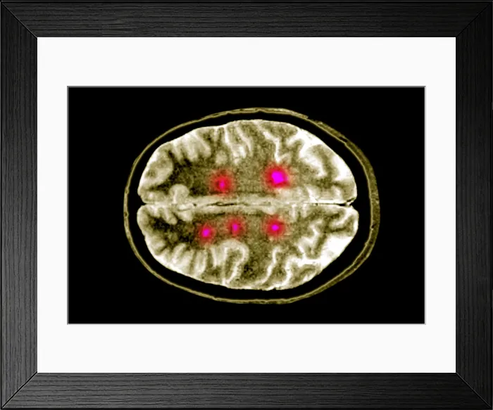 Framed Print : Brain scan of MS