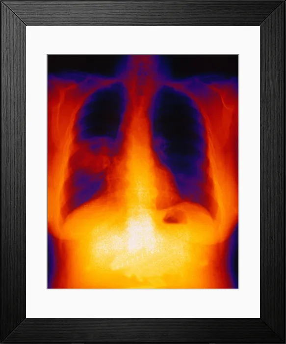Framed Print : Squamous Cell Carcinoma, Lungs, X-ray Framed Print : Squamous Cell Carcinoma, Lungs, X-ray