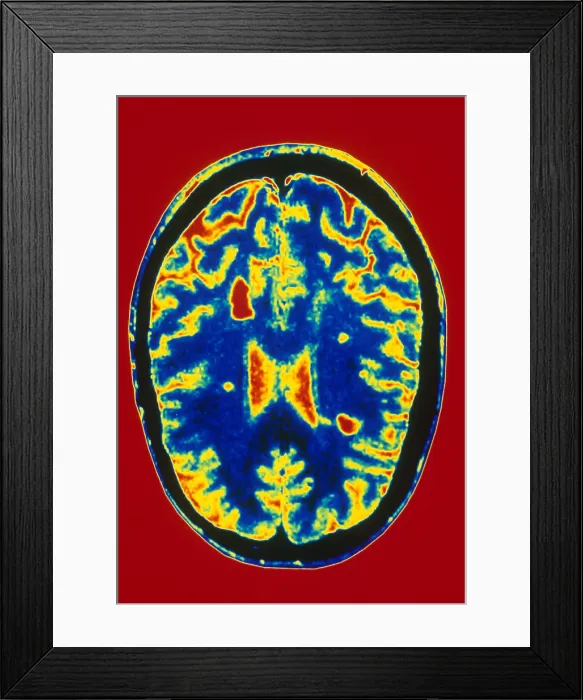 Framed Print : MRI Multiple Sclerosis Framed Print : MRI Multiple Sclerosis
