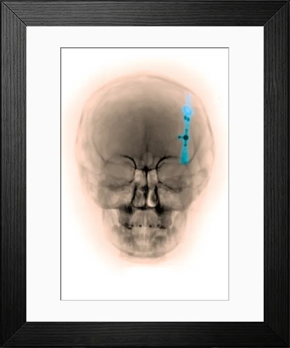 Framed Print : Skull x-ray of a shunt in the brain ventricle Framed Print : Skull x-ray of a shunt in the brain ventricle