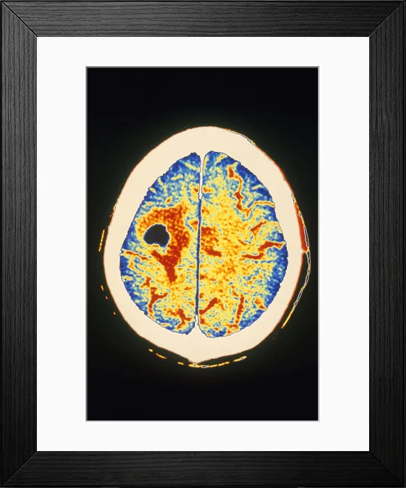 Framed Print : Brain Cancer & Edema, CT Scan Framed Print : Brain Cancer & Edema, CT Scan