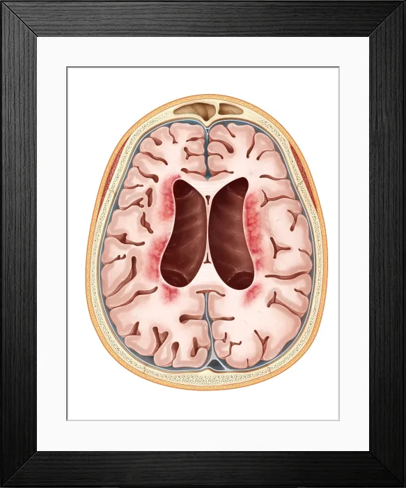 Framed Print : Neuronal Ceroid-Lipofuscinosis Framed Print : Neuronal Ceroid-Lipofuscinosis