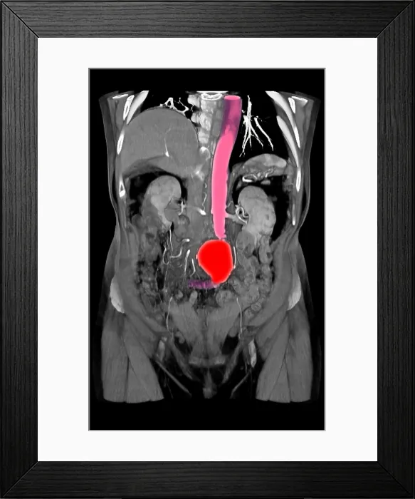Framed Print : CT Scan of Abdominal Aortic Aneurysm
