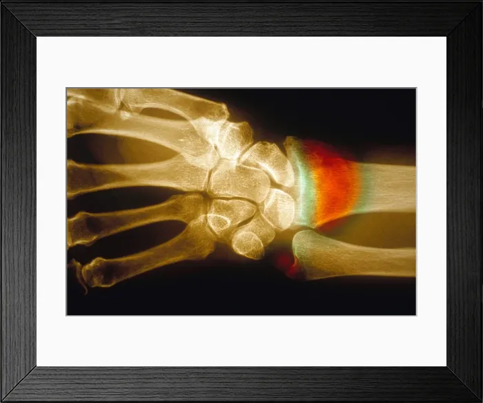 Framed Print : Colles Fracture, X-ray