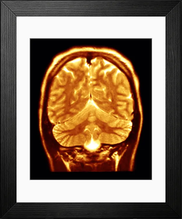 Framed Print : Cerebral MRI Framed Print : Cerebral MRI