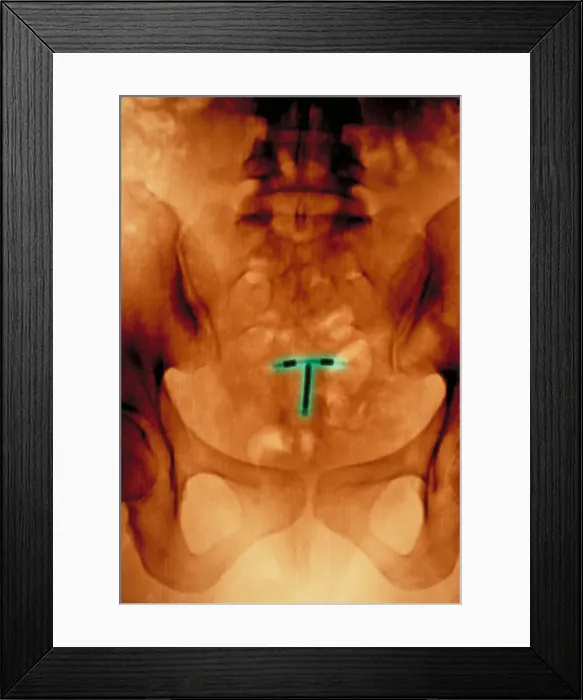 Framed Print : Abdomen x-ray Framed Print : Abdomen x-ray