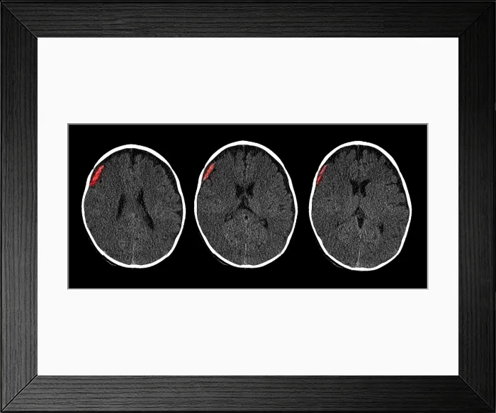 Framed Print : Subdural Hematoma in 6 Month Old, CT Scan