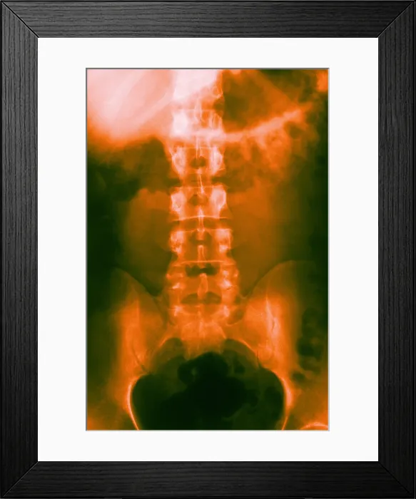 Framed Print : Normal Abdomen and Colon