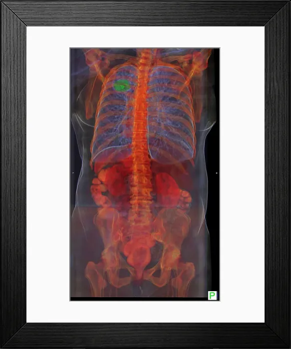 Framed Print : Lung Cancer, 3D CT Scan Framed Print : Lung Cancer, 3D CT Scan