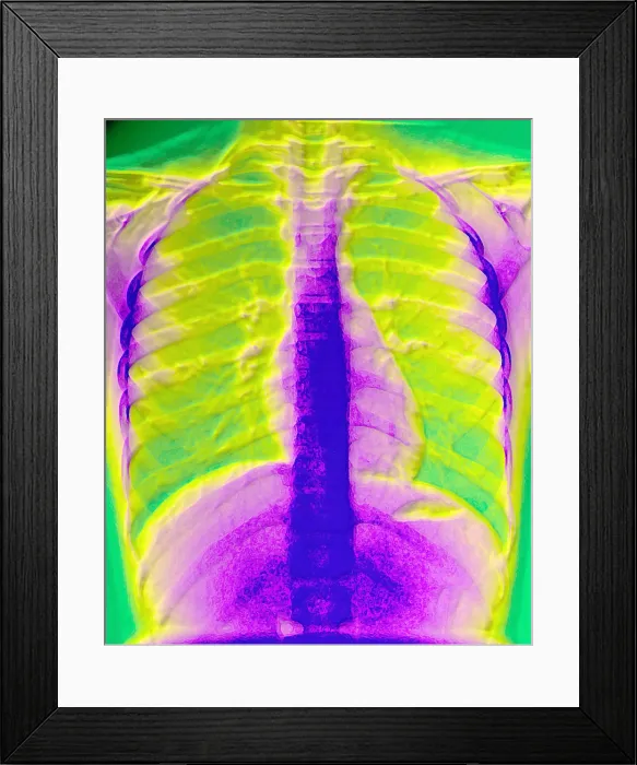 Framed Print : A normal chest X-ray Framed Print : A normal chest X-ray
