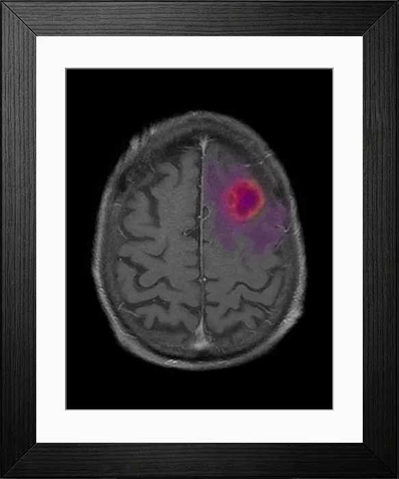 Framed Print : MRI of Encapsulated Abscess in Frontal Lobe