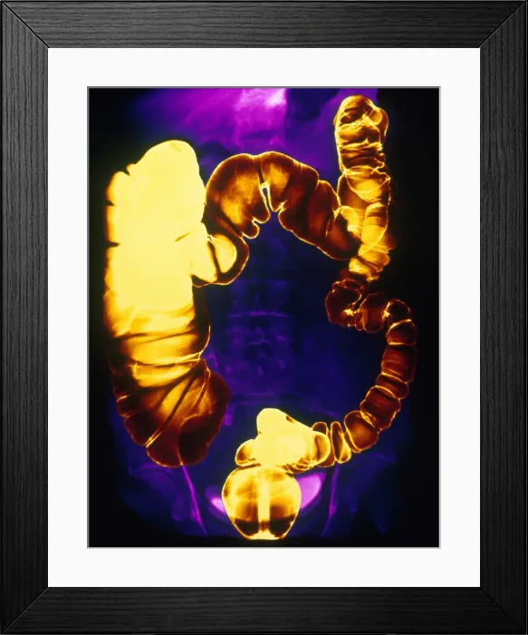 Framed Print : Large and Small Intestine, Barium X-ray Framed Print : Large and Small Intestine, Barium X-ray