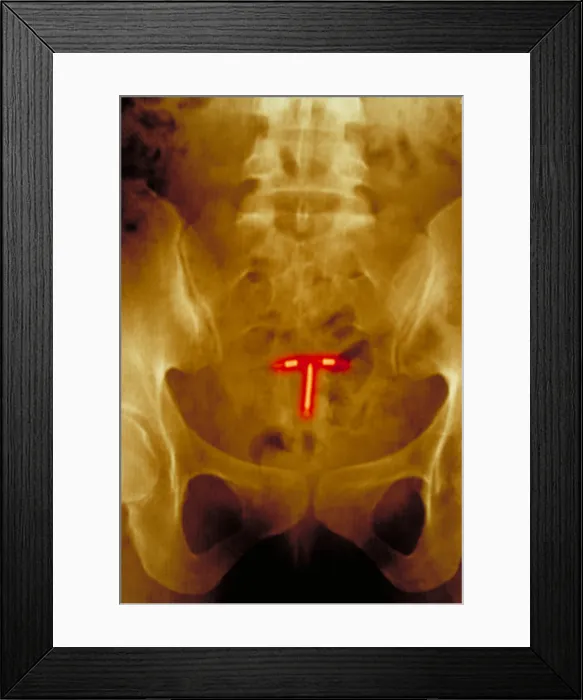 Framed Print : Abdomen x-ray Framed Print : Abdomen x-ray