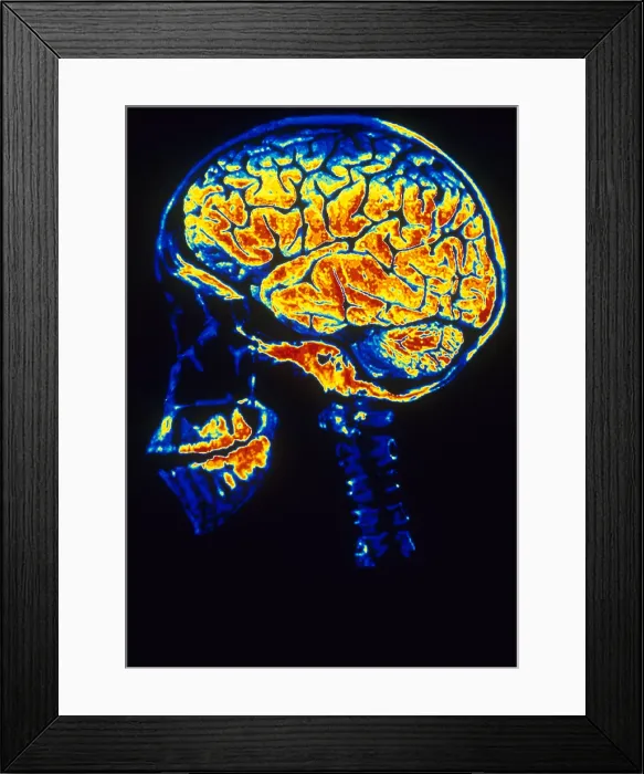 Framed Print : Skull With Brain Framed Print : Skull With Brain