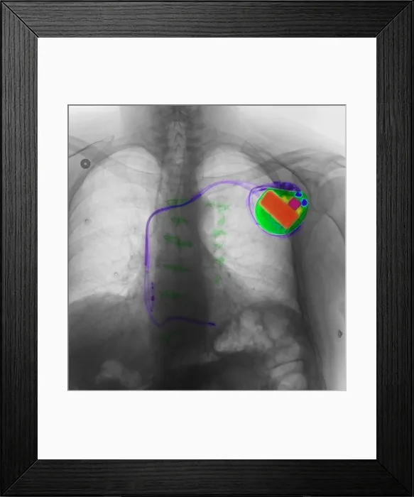 Framed Print : Pacemaker. Color-enhanced chest X-ray showing a pacemaker Framed Print : Pacemaker. Color-enhanced chest X-ray showing a pacemaker