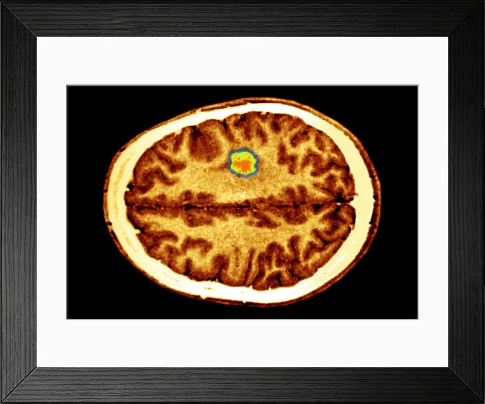 Framed Print : Glioma brain tumor Framed Print : Glioma brain tumor