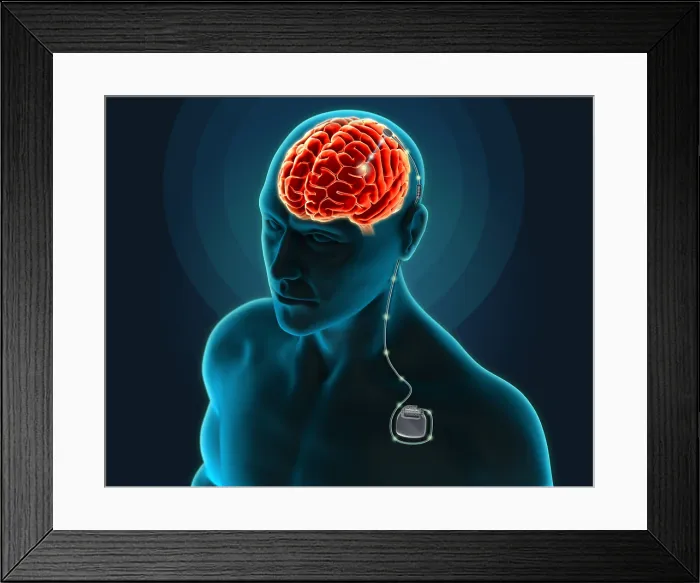 Framed Print : Deep Brain Stimulation, Illustration Framed Print : Deep Brain Stimulation, Illustration