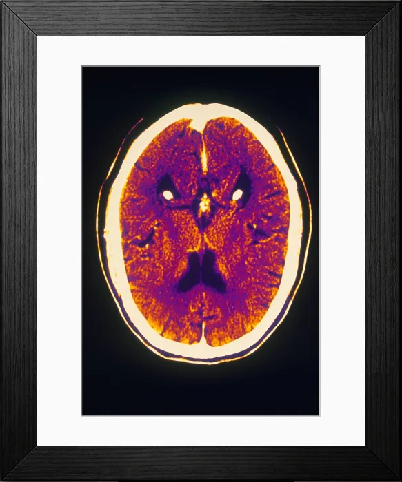 Framed Print : Brain, CT Scan Framed Print : Brain, CT Scan