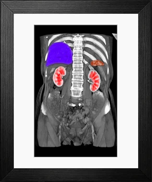 Framed Print : Coronal Reconstruction of CT Scan Showing Normal Anatomy