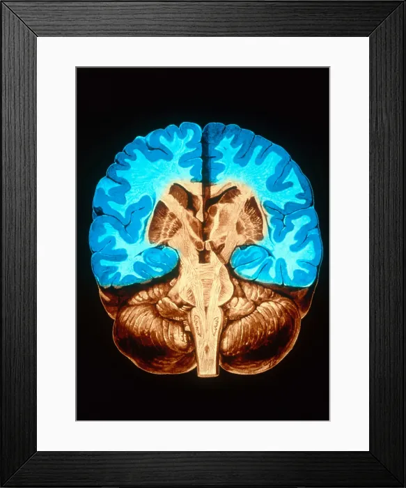 Framed Print : Brain, Coronal Section Framed Print : Brain, Coronal Section