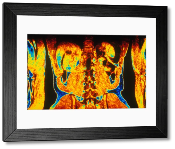 Framed Print : MRI of Human Torso Framed Print : MRI of Human Torso