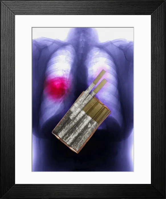 Framed Print : Cigarettes and Lung Cancer