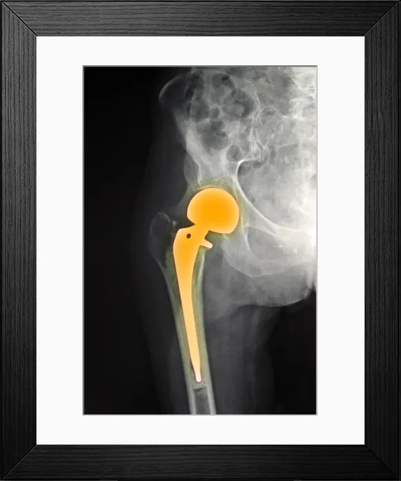 Framed Print : Hip Fracture with Prosthesis Framed Print : Hip Fracture with Prosthesis