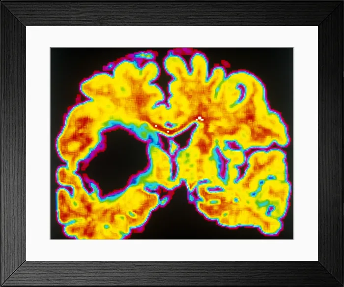 Framed Print : Brain hemorrhage Framed Print : Brain hemorrhage