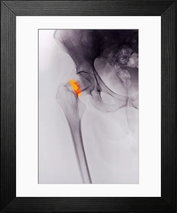 Framed Print : Hip Fracture X-Ray
