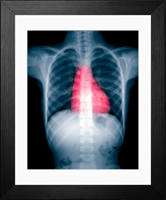 Framed Print : X-ray of thorax and abdomen Framed Print : X-ray of thorax and abdomen