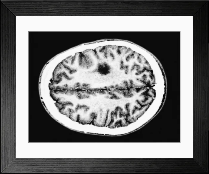 Framed Print : Glioma brain tumor Framed Print : Glioma brain tumor