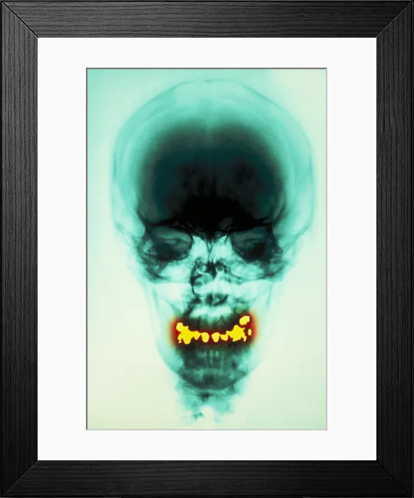 Framed Print : Dental fillings Framed Print : Dental fillings