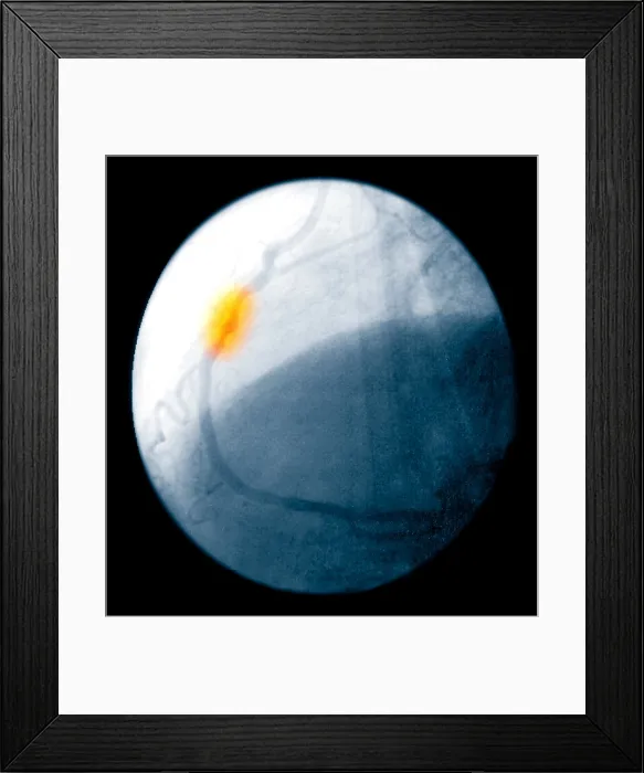 Framed Print : Angiogram of a blocked coronary artery Framed Print : Angiogram of a blocked coronary artery