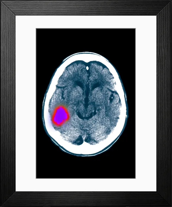 Framed Print : Temporal lobe stroke