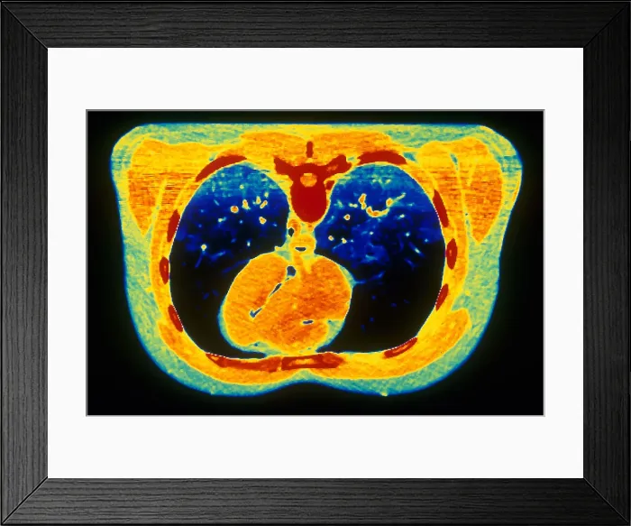 Framed Print : Chest & Heart, CT Scan Framed Print : Chest & Heart, CT Scan