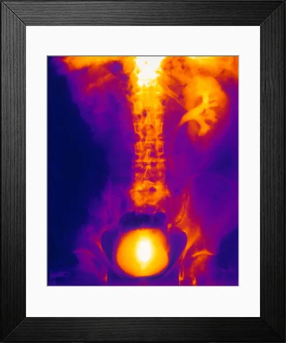 Framed Print : Blocked, Dilated Uterer (Kidney Stone) Framed Print : Blocked, Dilated Uterer (Kidney Stone)