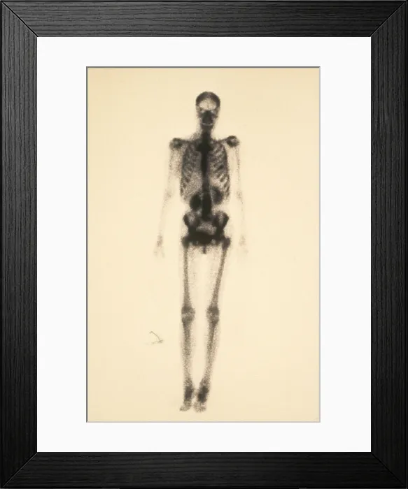 Framed Print : Normal Bone Scan Framed Print : Normal Bone Scan