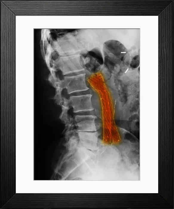 Framed Print : Aorto-Iliac Bypass Graft