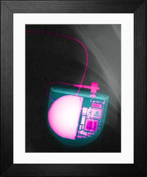 Framed Print : Pacemaker. Color enhanced x-ray of a pacemaker placed in a Bolivian patient Framed Print : Pacemaker. Color enhanced x-ray of a pacemaker placed in a Bolivian patient