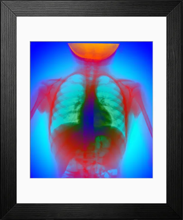 Framed Print : X-ray of chest Framed Print : X-ray of chest