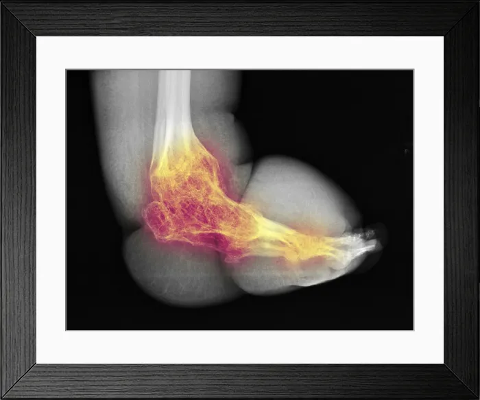 Framed Print : Severe Bone Degeneration in 63 Year Old Paraplegic Framed Print : Severe Bone Degeneration in 63 Year Old Paraplegic
